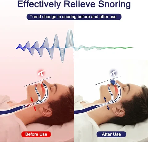 Micro CPAP device for anti-snoring